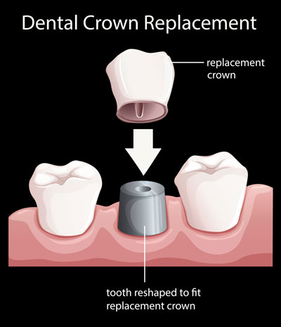 Diagram of how dental crown replacements work