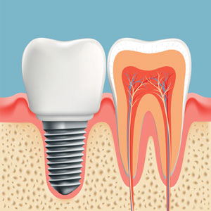 Cross section of a dental implant tooth and a natural tooth