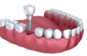 dental implant model illustrating the procedure
