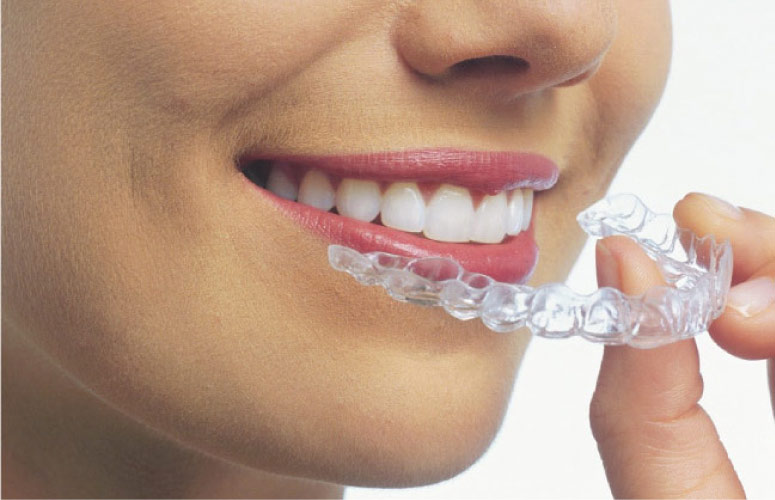 woman inserting ClearCorrect aligner orthodontics