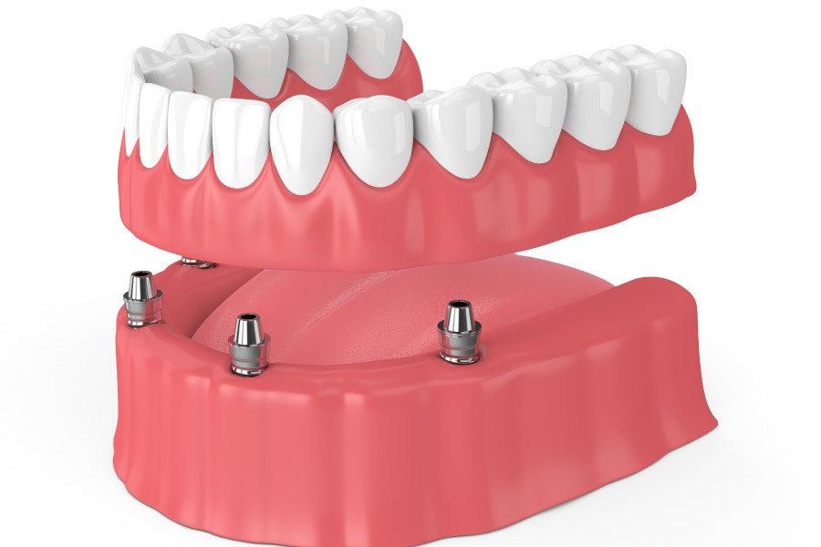 implant supported dentures model