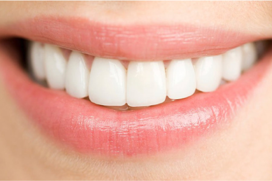 closeup of dental veneers on a woman's teeth