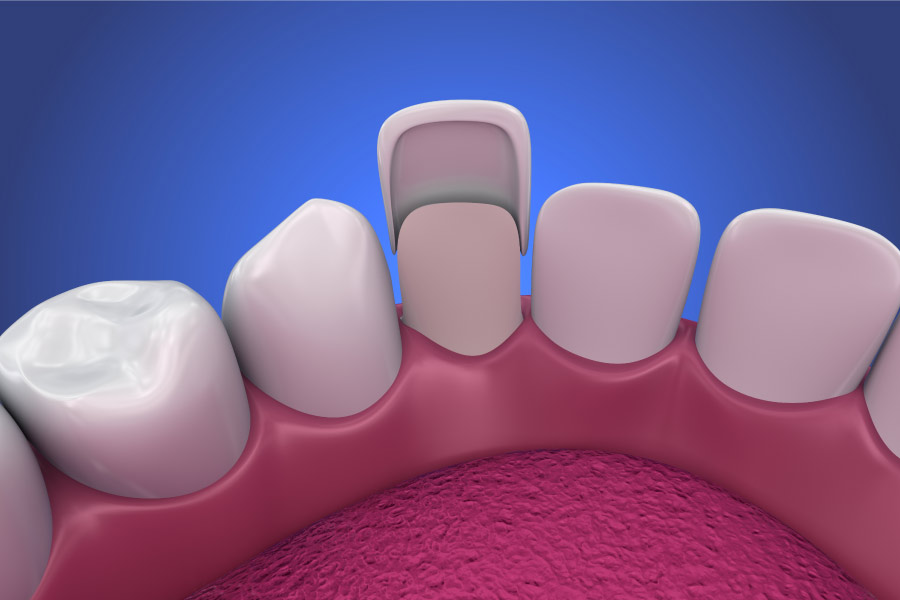 dental veneer depiction