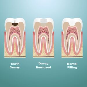 dental filling