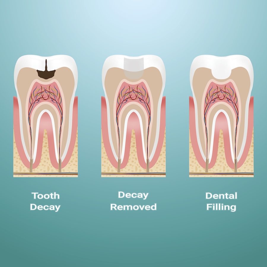 dental filling